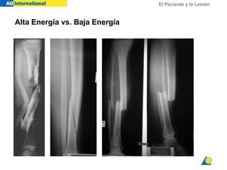 El Paciente y la Lesión
Alta Energía vs. Baja Energía
 