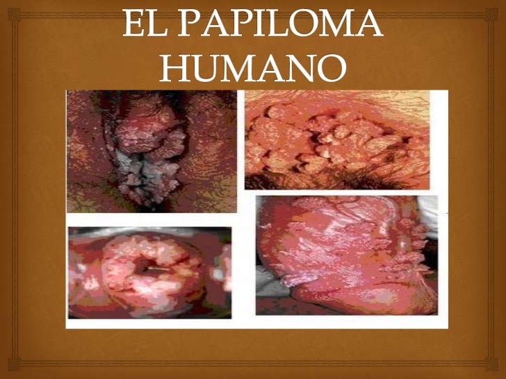 Como Curar El Papiloma Humano? Mi Historia De xito FOTOS 11 Como Curar El Papiloma Humano? Mi Historia De xito FOTOS 87