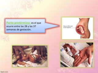 Parto pretérmino: es el que
ocurre entre las 28 y las 37
semanas de gestación.
 
