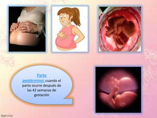 Parto
.
    postérmino: cuando el
    parto ocurre después de
       las 42 semanas de
            gestación
 