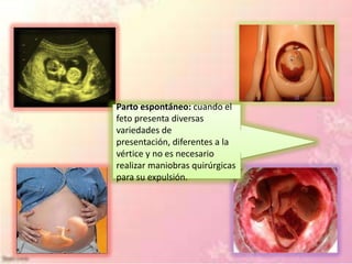 Parto espontáneo: cuando el
feto presenta diversas
variedades de
presentación, diferentes a la
vértice y no es necesario
realizar maniobras quirúrgicas
para su expulsión.
 