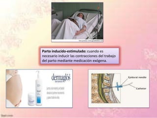 Parto inducido-estimulado: cuando es
necesario inducir las contracciones del trabajo
del parto mediante medicación exógena.
 