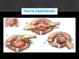PARTO ABDOMINAL
 