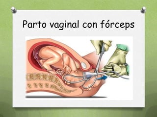Parto vaginal con fórceps
 