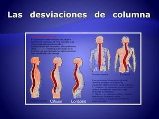 Cifosis Lordosis 
 
