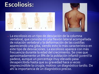  La escoliosis es un tipo de desviación de la columna 
vertebral, que consiste en una flexión lateral acompañada 
de rotación vertebral y la deformación de las costillas 
apareciendo una giba, siendo esto lo más característico en 
este tipo de desviaciones. La escoliosis aparece con más 
frecuencia durante la edad del crecimiento. Se cree que 
aproximadamente un 8% de la población infantil-juvenil la 
padece, aunque un porcentaje muy elevado pasa 
desapercibida hasta que su gravedad hace a veces 
imprescindible la cirugía; motivo: un diagnóstico tardío. De 
ahí la importancia de un diagnóstico precoz. 
 