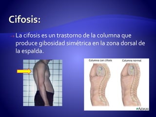  La cifosis es un trastorno de la columna que 
produce gibosidad simétrica en la zona dorsal de 
la espalda. 
 