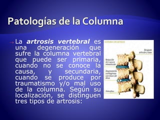  La artrosis vertebral es 
una degeneración que 
sufre la columna vertebral 
que puede ser primaria, 
cuando no se conoce la 
causa, y secundaria, 
cuando se produce por 
traumatismo y/o mal uso 
de la columna. Según su 
localización, se distinguen 
tres tipos de artrosis: 
 