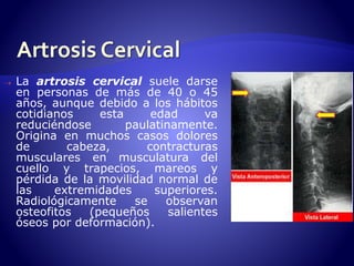  La artrosis cervical suele darse 
en personas de más de 40 o 45 
años, aunque debido a los hábitos 
cotidianos esta edad va 
reduciéndose paulatinamente. 
Origina en muchos casos dolores 
de cabeza, contracturas 
musculares en musculatura del 
cuello y trapecios, mareos y 
pérdida de la movilidad normal de 
las extremidades superiores. 
Radiológicamente se observan 
osteofitos (pequeños salientes 
óseos por deformación). 
 