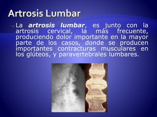  La artrosis lumbar, es junto con la 
artrosis cervical, la más frecuente, 
produciendo dolor importante en la mayor 
parte de los casos, donde se producen 
importantes contracturas musculares en 
los glúteos, y paravertebrales lumbares. 
 