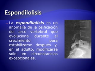  La espondilolisis es un 
anomalía de la osificación 
del arco vertebral que 
evoluciona durante el 
crecimiento para 
estabilizarse después y, 
en el adulto, modificarse 
sólo en circunstancias 
excepcionales. 
 
