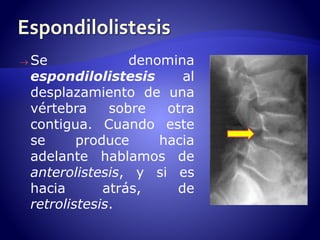 Se denomina 
espondilolistesis al 
desplazamiento de una 
vértebra sobre otra 
contigua. Cuando este 
se produce hacia 
adelante hablamos de 
anterolistesis, y si es 
hacia atrás, de 
retrolistesis. 
 