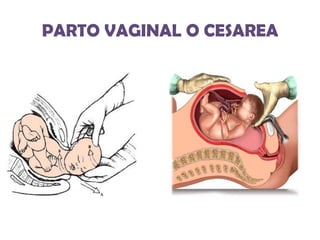 PARTO VAGINAL O CESAREA

 