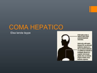 COMA HEPATICO
Elsa larota taype
 