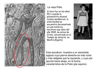 Si bien fue en los años 50's cuando la poliomielitis alcanzó niveles epidémicos, la enfermedad se encuentra documentada en una histórica escultura que data del año 1500, de antes de Cristo, encontrada en el Templo de Astarte, en Menfis (Egipto)  La vieja Polio  Esta escultura  muestra a un sacerdote egipcio cuya pierna derecha es más corta y más delgada que la izquierda, y cuyo pie apunta hacia abajo, en la forma característica de la Polio (pie equino).  