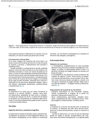 28 A. Segura Grau et al.
A B
Figura 2 Corte longitudinal en el hipocondrio derecho. A: colelitiasis, imagen intravesicular hiperecogénica con sombra posterior
a nivel del cuello. B: barro biliar, ocupación de la porción más declive de la vesícula con material ecogénico y con nivel horizontal.
como espacios quísticos e hipoecoicos en la pared, con ecos
brillantes y en cola de cometa que parten de la misma.
Carcinoma de la vesícula biliar
Es el tumor maligno más frecuente del tracto biliar y el
quinto o sexto más frecuente del tracto GI. Es más frecuente
en mujeres y ancianos, y habitualmente está asociado a
colelitiasis (75%).
Estudio ecográﬁco: su presentación es variada, pudiendo
aparecer como una masa centrada en la fosa vesicular con
colelitiasis asociada y a veces con cálculo atrapado por el
tumor, o como una masa polipoidea intraluminal prominente
(la forma menos común, que casi siempre mide más de 1 cm y
con vascularización interna prominente), con engrosamiento
focal o difuso de la pared (de forma irregular y con pérdida
de las capas murales normales), distensión de la vesícula e
inﬁltración de las estructuras adyacentes (hígado, vasos y
vías biliares, adenopatías periportales, peripancreáticas
y mesentéricas) (ﬁg. 3).
Metástasis
El melanoma es el tumor que con mayor frecuencia se
extiende a la vesícula (50-60%)11
. Aparece como lesio-
nes hiperecoicas, polipoideas de base ancha y múltiples.
A menudo son mayores de 10 mm. La detección de pólipos
en pacientes con antecedentes de melanoma debe extre-
marse. El carcinoma hepatocelular puede invadir la vesícula
a través de invasión directa.
Vía biliar
Aspectos técnicos y anatomía ecográﬁca
La exploración se realiza en decúbito supino o decúbito late-
ral izquierdo. Se efectúa un corte longitudinal oblicuo. Las
vías biliares intrahepáticas no son visibles en condiciones
normales. Las vías biliares extrahepéticas se visualizan en
forma de tubo alargado y anecogénico.
Enfermedad difusa
Dilatación de vías biliares
- A. Intrahepáticas: ecográﬁcamente en casos avanzados
aparecen como estructuras tubulares anecogénicas y tor-
tuosas; su calibre va disminuyendo desde el hilio a la
periferia, formando una imagen llamada «en estrella o en
brazos de pulpo»12
.
- B. Extrahepáticas: hay dilatación cuando el diámetro del
colédoco es superior a 8 mm. Entre 6-8 mm es dudoso,
y en caso de colecistectomía, es normal hasta 10 mm. Apa-
rece como estructura tubular anecogénica, anterior a la
vena porta, originando la imagen llamada «doble canal o
en ca˜nón de escopeta»12
. El doppler facilita su diferencia-
ción (ﬁg. 4).
Engrosamiento de la pared de las vías biliares
- Colangitis esclerosante (lo más frecuente): engrosa-
miento circunferencial o irregular de la pared con
estenosis o dilataciones focales de la luz.
- Otros: coledocolitiasis, pancreatitis, colangitis ascen-
dente, colangiopatía del sida, colangiocarcinoma, colan-
gitis piogénica, prótesis biliares, trombosis portal.
Ictericia
La ecografía es la técnica de elección para el estudio de
la ictericia. La dilatación del árbol biliar permite distin-
guirla de la causa parenquimatosa, aunque su ausencia no
la excluye.
Localiza la obstrucción y el nivel de esta (la dilatación
puede ser desde la porción intrapancreática del colé-
doco hasta vías biliares intrahepáticas). La ecografía puede
Documento descargado de http://www.elsevier.es el 11/10/2016. Copia para uso personal, se prohíbe la transmisión de este documento por cualquier medio o formato.
 