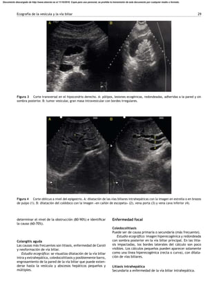 Ecografía de la vesícula y la vía biliar 29
A B
Figura 3 Corte transversal en el hipocondrio derecho. A: pólipos, lesiones ecogénicas, redondeadas, adheridas a la pared y sin
sombra posterior. B: tumor vesicular, gran masa intravesicular con bordes irregulares.
1
2
3
4
A B000 000
Figura 4 Corte oblicuo a nivel del epigastrio. A: dilatación de las vías biliares intrahepáticas con la imagen en estrella o en brazos
de pulpo (1). B: dilatación del colédoco con la imagen «en ca˜nón de escopeta» (2), vena porta (3) y vena cava inferior (4).
determinar el nivel de la obstrucción (80-90%) e identiﬁcar
la causa (60-70%).
Colangitis aguda
Las causas más frecuentes son litiasis, enfermedad de Caroli
y neoformación de vía biliar.
Estudio ecográﬁco: se visualiza dilatación de la vía biliar
intra y extrahepática, coledocolitiasis y posiblemente barro,
engrosamiento de la pared de la vía biliar que puede exten-
derse hasta la vesícula y abscesos hepáticos peque˜nos y
múltiples.
Enfermedad focal
Coledocolitiasis
Puede ser de causa primaria o secundaria (más frecuente).
Estudio ecográﬁco: imagen hiperecogénica y redondeada
con sombra posterior en la vía biliar principal. En las litia-
sis impactadas, los bordes laterales del cálculo son poco
visibles. Los cálculos peque˜nos pueden aparecer solamente
como una línea hiperecogénica (recta o curva), con dilata-
ción de vías biliares.
Litiasis intrahepática
Secundaria a enfermedad de la vía biliar intrahepática.
Documento descargado de http://www.elsevier.es el 11/10/2016. Copia para uso personal, se prohíbe la transmisión de este documento por cualquier medio o formato.
 
