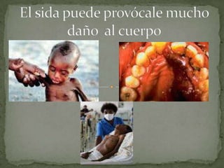 El sida puede provócale mucho daño  al cuerpo