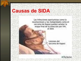Causas de SIDA 