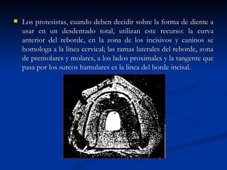    Los protesistas, cuando deben decidir sobre la forma de diente a
    usar en un desdentado total, utilizan este recurso: la curva
    anterior del reborde, en la zona de los incisivos y caninos se
    homologa a la línea cervical; las ramas laterales del reborde, zona
    de premolares y molares, a los lados proximales y la tangente que
    pasa por los surcos hamulares es la línea del borde incisal.
 
