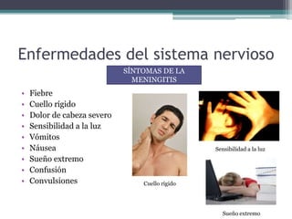 Enfermedades del sistema nervioso
• Fiebre
• Cuello rígido
• Dolor de cabeza severo
• Sensibilidad a la luz
• Vómitos
• Náusea
• Sueño extremo
• Confusión
• Convulsiones
SÍNTOMAS DE LA
MENINGITIS
Sensibilidad a la luz
Cuello rígido
Sueño extremo
 