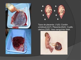 Tipos de placenta: (1)(5): Cordón
umbilical;(2)(7): Placenta;(8)(4): Cuello
uterino;(3)(6): Vaso sanguíneo fetal.
 