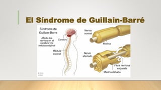 El Síndrome de Guillain-Barré
 