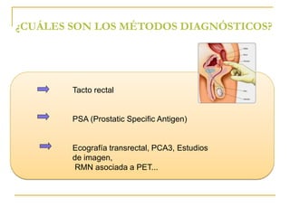 ¿CUÁLES SON LOS MÉTODOS DIAGNÓSTICOS? 
Tacto rectal 
PSA (Prostatic Specific Antigen) 
Ecografía transrectal, PCA3, Estudios 
de imagen, 
RMN asociada a PET... 
 