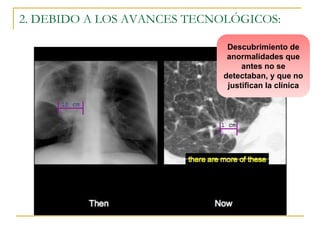 2. DEBIDO A LOS AVANCES TECNOLÓGICOS: 
Descubrimiento de 
anormalidades que 
antes no se 
detectaban, y que no 
justifican la clínica 
 