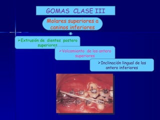 GOMAS  CLASE III Molares superiores a caninos inferiores Extrusión de  dientes  postero superiores Volcamiento  de los antero superiores Inclinación lingual de los antero inferiores 