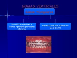 GOMAS VERTICALES Gomas  triangulares De caninos superiores a caninos y primeros premolares inferiores Cerrando mordidas abiertas de 0.5 a 1.5mm 