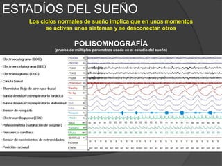 Los ciclos de sueño y
vigilia están regulados
por una serie de
núcleos localizados en
el tronco encefálico
que se proyectan
hacia el encéfalo y
médula espinal.
Estados Encefálicos controlados con
precisión
Éste estado se
desarrolla en
todos los
mamíferos y
posiblemente en
todos los
vertebrados
No es consecuencia de una disminución de la actividad cerebral sino de una
compleja red de activaciones e inhibiciones de distintos circuitos neuronales.
 
