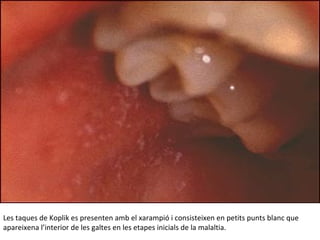 Les taques de Koplik es presenten amb el xarampió i consisteixen en petits punts blanc que
apareixena l’interior de les galtes en les etapes inicials de la malaltia.
 