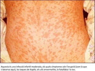 Aquesta és una infecció infantil moderada, els quals símptomes són l’erupció (com la que
s’observa aquí), les taques de Koplik, els ulls envermellits, la fotofòbia i la tos.
 