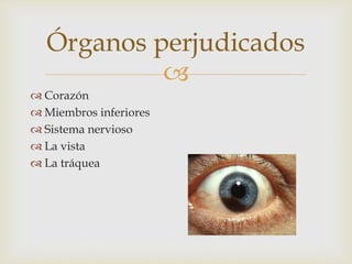 Órganos perjudicados 
 
 Corazón 
 Miembros inferiores 
 Sistema nervioso 
 La vista 
 La tráquea 
 