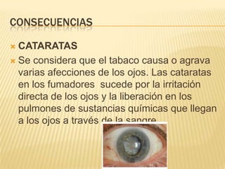 CONSECUENCIAS

 CATARATAS
 Se considera que el tabaco causa o agrava
  varias afecciones de los ojos. Las cataratas
  en los fumadores sucede por la irritación
  directa de los ojos y la liberación en los
  pulmones de sustancias químicas que llegan
  a los ojos a través de la sangre.
 