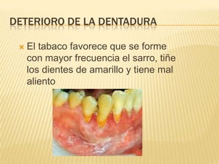 DETERIORO DE LA DENTADURA

    El tabaco favorece que se forme
     con mayor frecuencia el sarro, tiñe
     los dientes de amarillo y tiene mal
     aliento
 