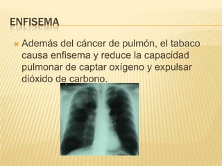 ENFISEMA
   Además del cáncer de pulmón, el tabaco
    causa enfisema y reduce la capacidad
    pulmonar de captar oxígeno y expulsar
    dióxido de carbono.
 