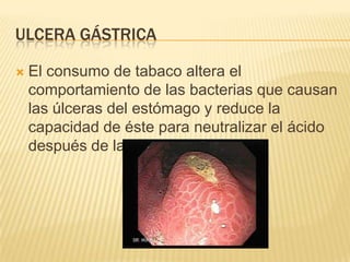 ULCERA GÁSTRICA

   El consumo de tabaco altera el
    comportamiento de las bacterias que causan
    las úlceras del estómago y reduce la
    capacidad de éste para neutralizar el ácido
    después de las comidas.
 