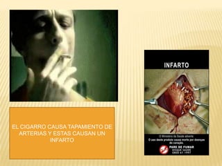 EL CIGARRO CAUSA TAPAMIENTO DE
  ARTERIAS Y ESTAS CAUSAN UN
            INFARTO
 