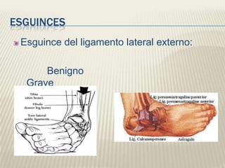 ESGUINCES
 Esguince del ligamento lateral externo:

      Benigno
  Grave
 