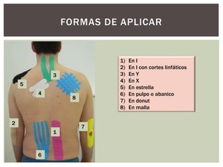 FORMAS DE APLICAR
1
2
3
4
5
6
7
8
1) En I
2) En I con cortes linfáticos
3) En Y
4) En X
5) En estrella
6) En pulpo o abanico
7) En donut
8) En malla
 