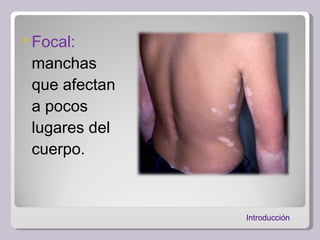 Focal:  manchas que afectan a pocos lugares del cuerpo. Introducción  