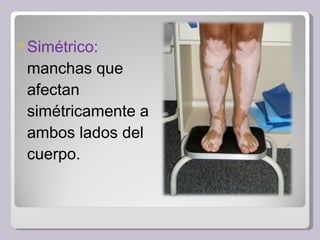 Simétrico:  manchas que afectan simétricamente a ambos lados del cuerpo. 