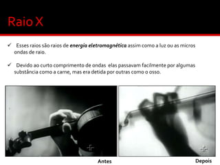 Raio X
 Esses raios são raios de energia eletromagnética assim como a luz ou as micros
ondas de raio.

 Devido ao curto comprimento de ondas elas passavam facilmente por algumas
substância como a carne, mas era detida por outras como o osso.

Antes

Depois

 