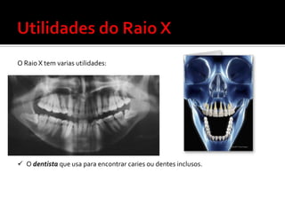 O Raio X tem varias utilidades:

 O dentista que usa para encontrar caries ou dentes inclusos.

 