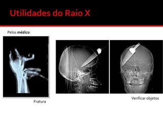 Pelos médico:

Fratura

Verificar objetos

 