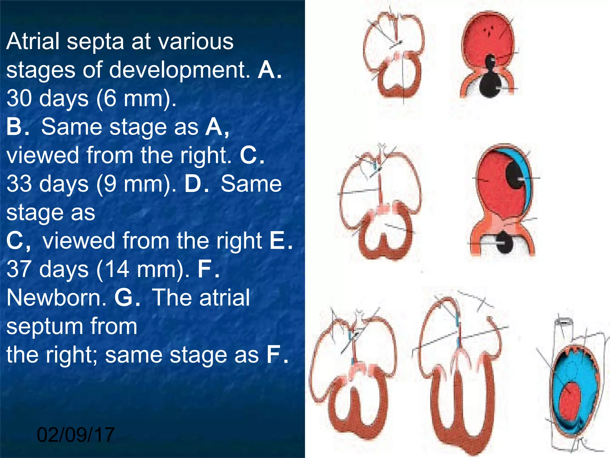02/09/17
Atrial septa at various
stages of development. A.
30 days (6 mm).
B. Same stage as A,
viewed from the right. C.
33 days (9 mm). D. Same
stage as
C, viewed from the right E.
37 days (14 mm). F.
Newborn. G. The atrial
septum from
the right; same stage as F.
 