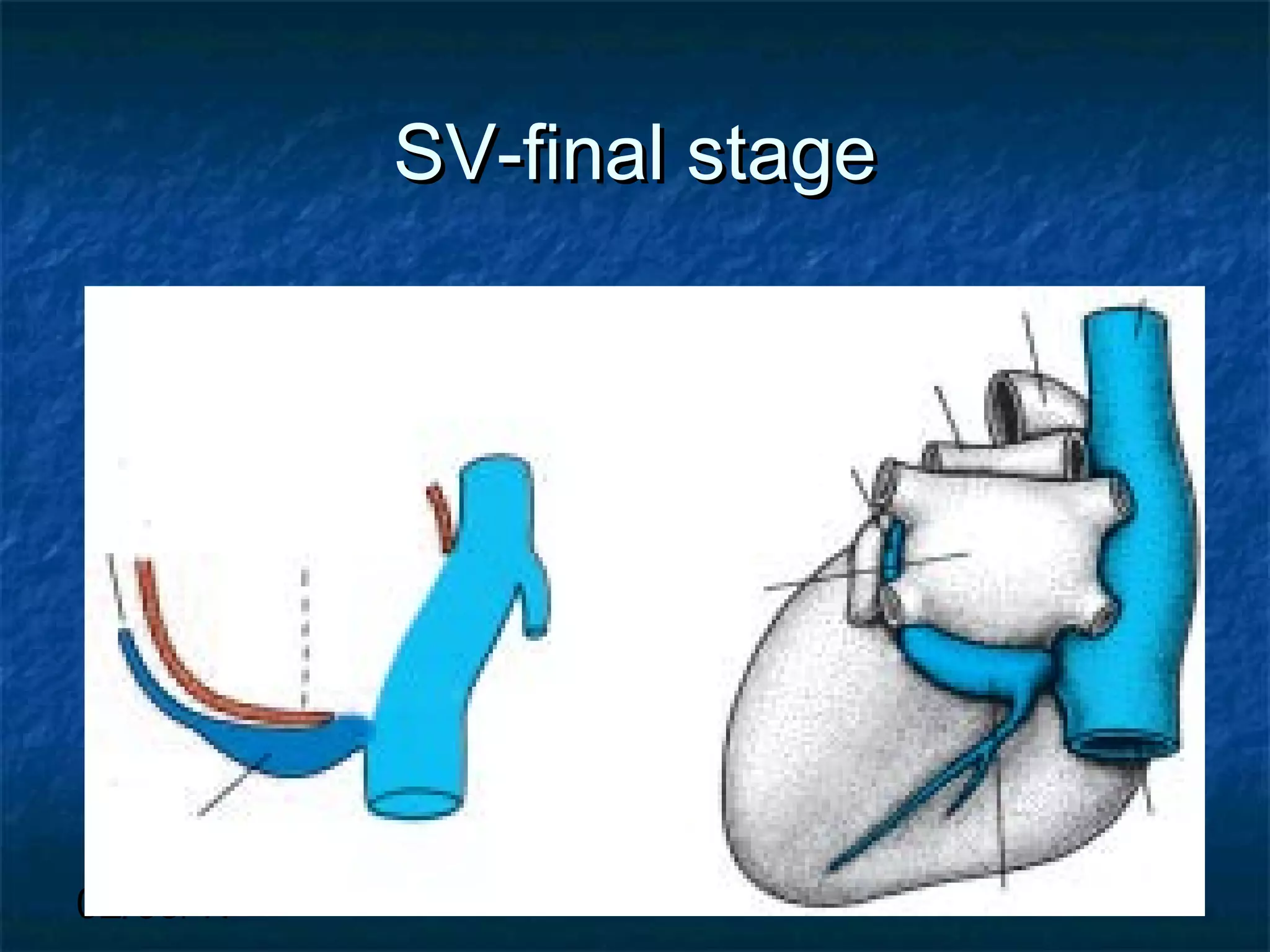 02/09/17
SV-final stageSV-final stage
 