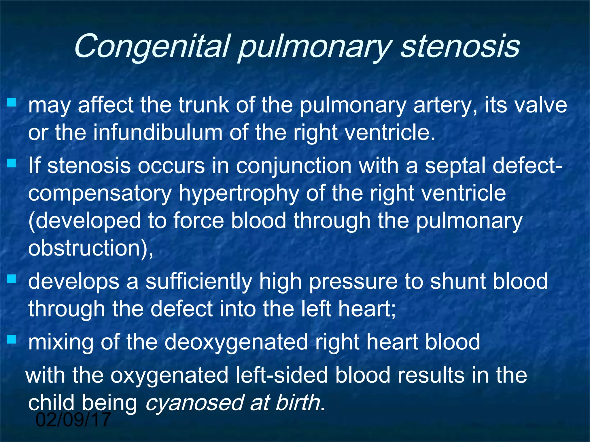 02/09/17
Congenital pulmonary stenosis
 may affect the trunk of the pulmonary artery, its valve
or the infundibulum of the right ventricle.
 If stenosis occurs in conjunction with a septal defect-
compensatory hypertrophy of the right ventricle
(developed to force blood through the pulmonary
obstruction),
 develops a sufficiently high pressure to shunt blood
through the defect into the left heart;
 mixing of the deoxygenated right heart blood
with the oxygenated left-sided blood results in the
child being cyanosed at birth.
 